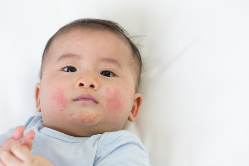 eczema child skin rash