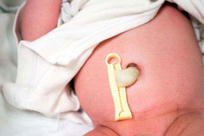 umbilical cord clamping