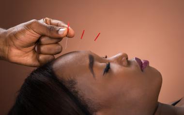 cosmetic acupuncture traditional chinese medicine