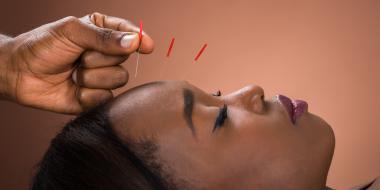 cosmetic acupuncture traditional chinese medicine